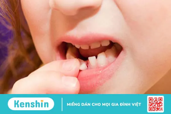 Chứng rối loạn ngôn ngữ ở trẻ: Những biểu hiện cha mẹ cần biết 2