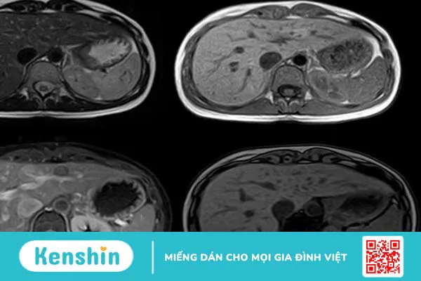 Chụp MRI gan: Vai trò, ưu điểm, nhược điểm và quy trình thực hiện 2