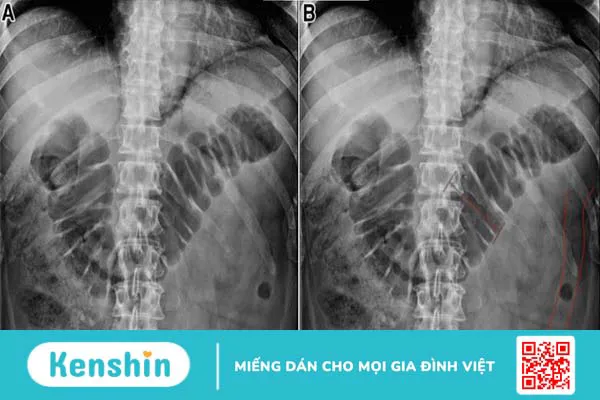 Chụp X quang tắc ruột là phương pháp gì?