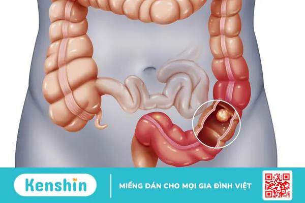 Chụp X quang tắc ruột là phương pháp gì?