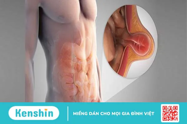 Chụp X-quang tắc ruột: Quy trình chụp X-quang tắc ruột như thế nào? 1