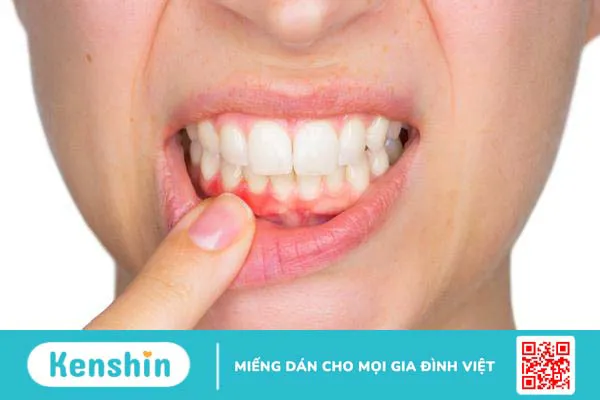 Tẩy trắng răng có thể gây kích ứng nướu răng