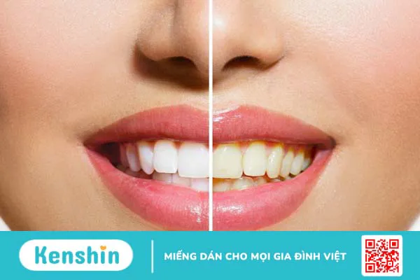 Tẩy trăng răng có thể không đạt mong muốn nếu răng của bạn quá xỉn màu