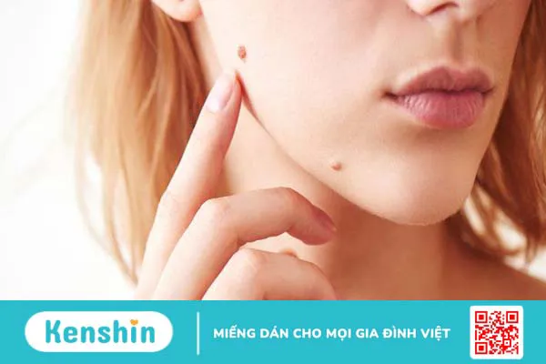 Có nên sử dụng kem tẩy nốt ruồi không? Vì sao? 2