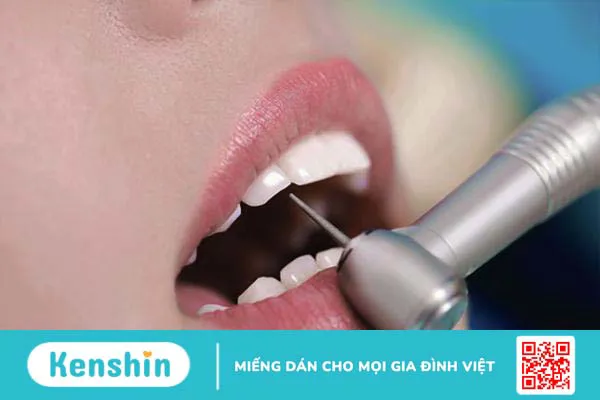 Có nên thực hiện mài răng cửa không và cần lưu ý gì khi mài răng cửa? 1