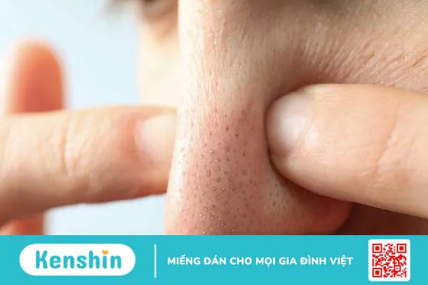 Có nên nặn mụn hay không? 3