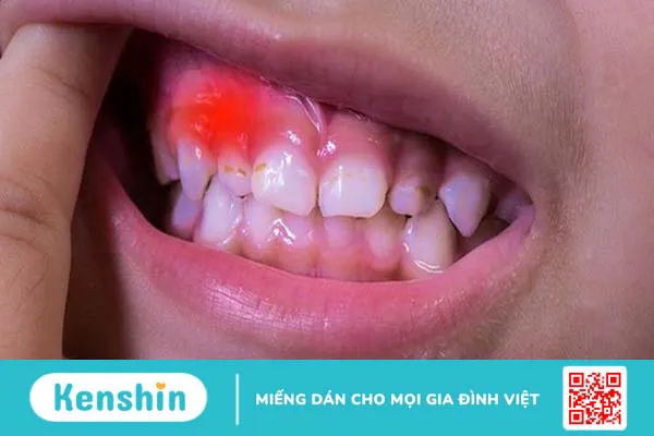 Cách chữa viêm lợi cho trẻ dưới 2 tuổi hiện nay? Các lưu ý gì khi điều trị viêm lợi cho trẻ+3