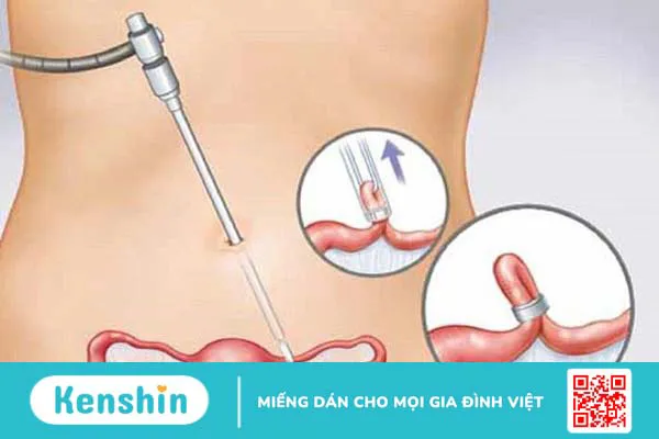 Có thể thụ tinh nhân tạo sau khi đã cắt 2 vòi trứng được không? Có còn cơ hội làm mẹ không?