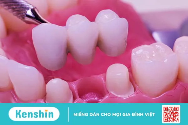 Cùng tìm hiểu nhược điểm của cầu răng sứ 1