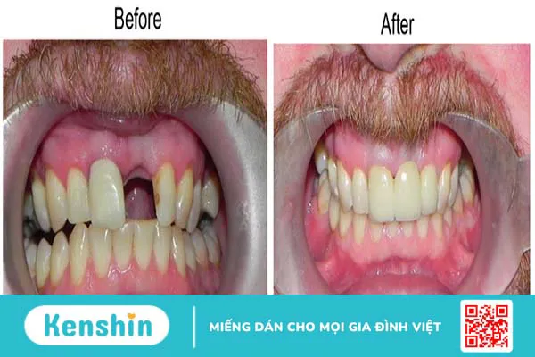 Cùng tìm hiểu nhược điểm của cầu răng sứ 2