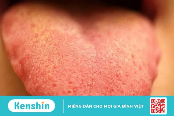 Cuống lưỡi nổi mụn đỏ: Nguyên nhân, triệu chứng, cách khắc phục và phòng ngừa 1