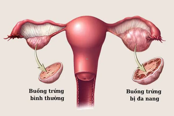 Góc giải đáp: Đa nang buồng trứng có chữa được không? 2