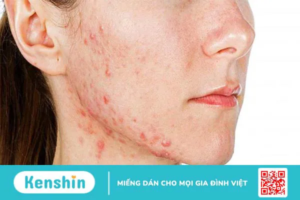 Da nhiễm corticoid - Điều trị sao cho hiệu quả?1