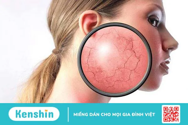 Da nhiễm corticoid - Điều trị sao cho hiệu quả?2