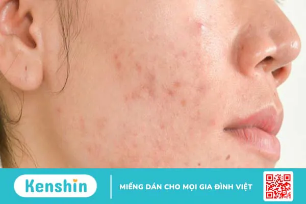 Da nhiễm corticoid - Điều trị sao cho hiệu quả?3