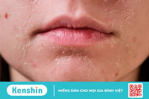 Góc Skincare: Chăm sóc da khô và những điều cần biết 1