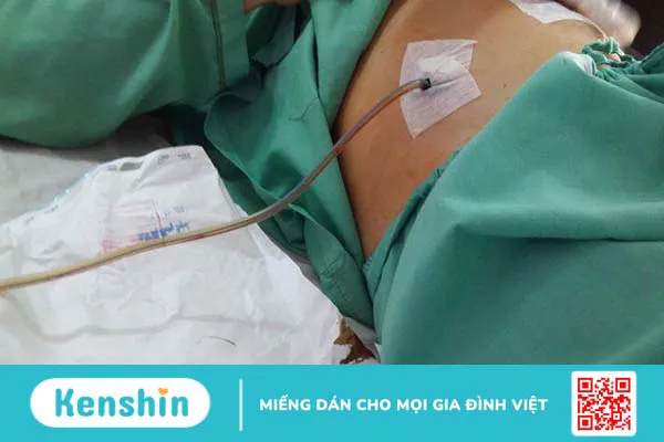 Dẫn lưu là gì? Cách chăm sóc cho người bệnh sử dụng ống dẫn lưu 0