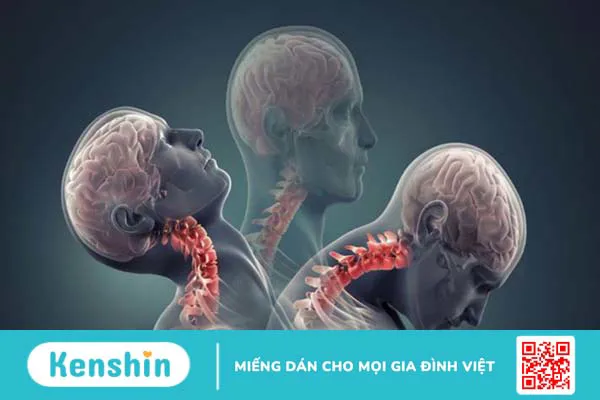 Đau buốt cơ ở cổ dưới gáy do nguyên nhân gì? Cách điều trị và phòng ngừa `