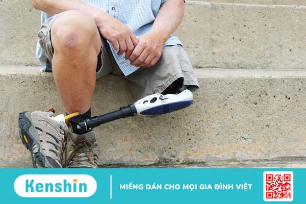 Đau chi ma là gì? Khi nào xuất hiện cơn đau chi ma? 2