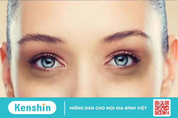 Dấu hiệu đeo kính râm trong chấn thương sọ não là gì? 1