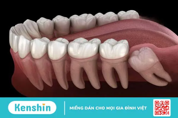 Dấu hiệu nhận biết răng khôn mọc lệch 1