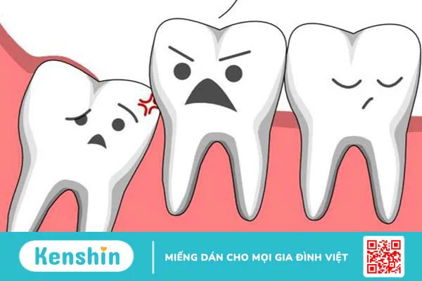 Dấu hiệu nhận biết răng khôn mọc lệch 2