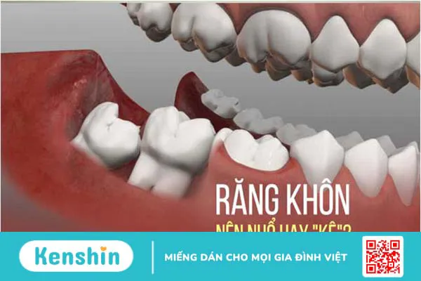 Dấu hiệu nhận biết răng khôn mọc lệch 3