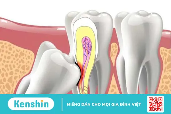 Dấu hiệu răng khôn bị sâu và cách chăm sóc sau nhổ răng 4