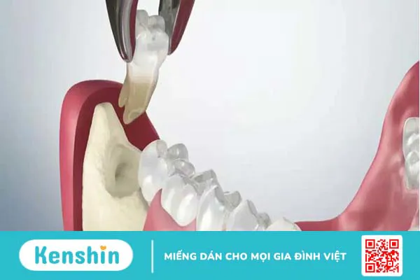 Dấu hiệu răng khôn bị sâu và cách chăm sóc sau nhổ răng 3