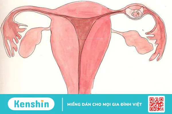 Dấu hiệu thai ngoài tử cung sau chuyển phôi 1