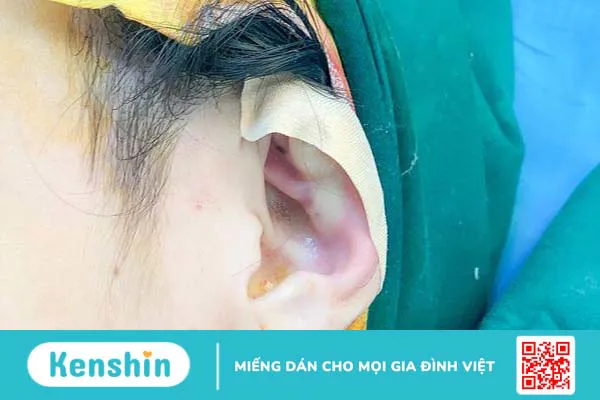 Dấu hiệu và cách điều trị viêm sụn vành tai hiệu quả nhất 3