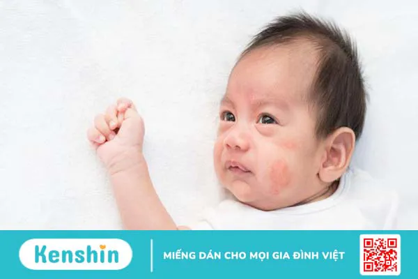 dị ứng sữa công thức 1