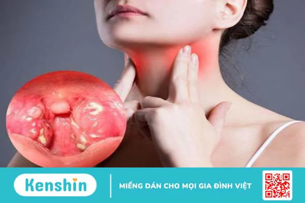 Đau họng một bên là bệnh gì? Nguyên nhân và cách phòng tránh? 2