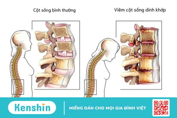 Đau lưng kiểu viêm là bệnh gì và nó có liên quan đến viêm cột sống dính khớp? 2