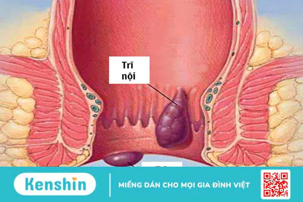 Đi ngoài ra chất nhầy màu hồng - Lời cảnh báo của cơ thể 2