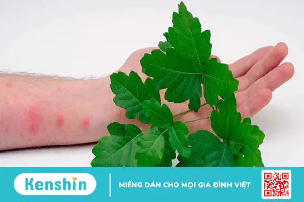 Dị ứng cây sơn độc: Nguyên nhân và cách phòng tránh dị ứng 1