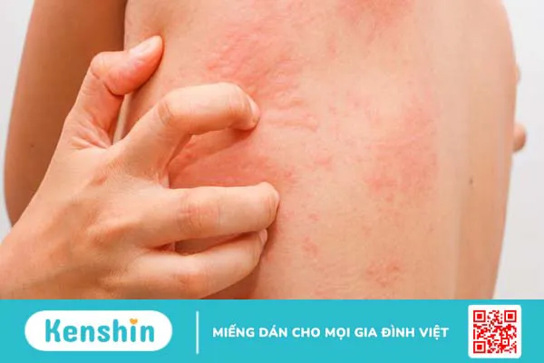 Dị ứng cây sơn độc: Nguyên nhân và cách phòng tránh dị ứng 2