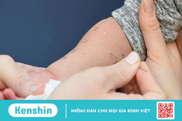 Dị ứng sữa: Nguyên nhân, triệu chứng, chẩn đoán và cách điều trị 2