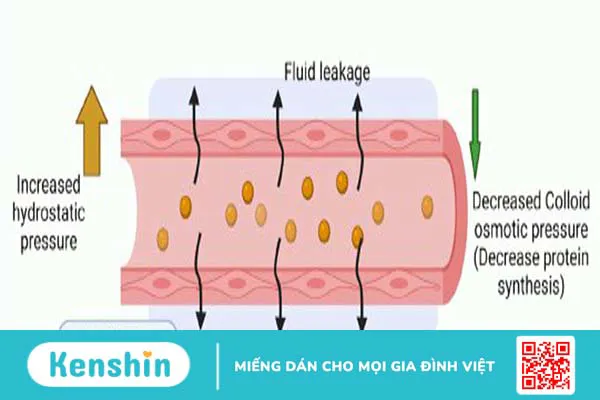 Dịch thấm và dịch tiết khác nhau như thế nào? Cách chẩn đoán phân biệt 1