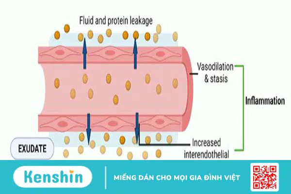 Dịch thấm và dịch tiết khác nhau như thế nào? Cách chẩn đoán phân biệt 2