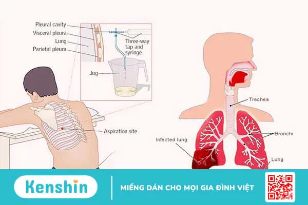 Dịch thấm và dịch tiết khác nhau như thế nào? Cách chẩn đoán phân biệt 4