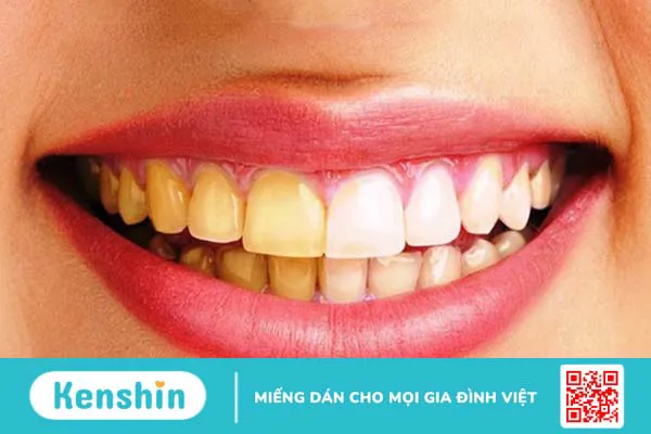 Điểm mặt 8 thói quen sai lầm khiến răng bị ố vàng mà bạn nên biết 3