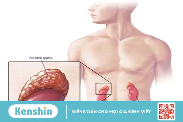 Tăng sản thượng thận bẩm sinh gây mức testosteron cao ở nữ giới