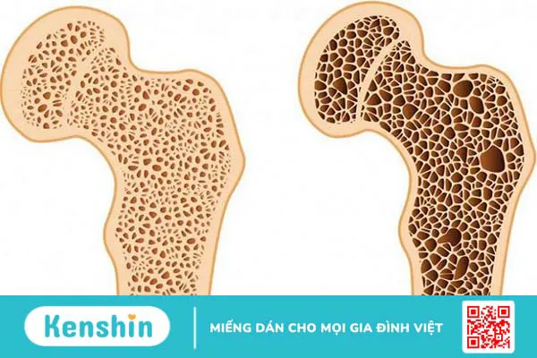 Đo loãng xương bao nhiêu tiền? Cập nhật mới nhất 3