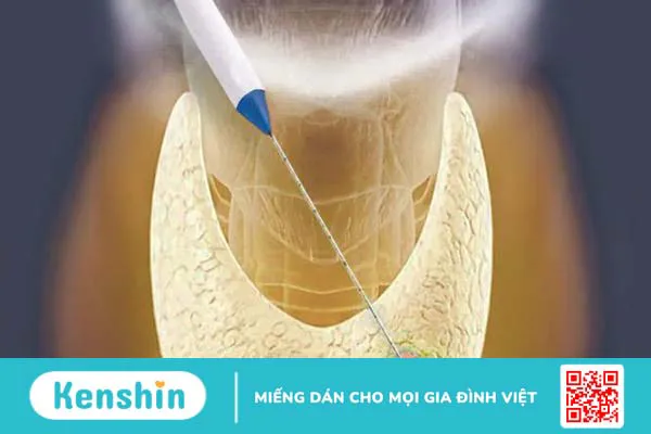 Đốt sóng cao tần: Phương pháp điều trị được ứng dụng hiệu quả 2