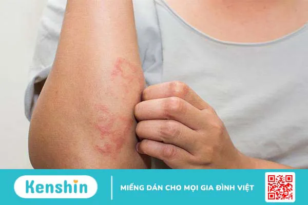 Dùng cây ngải dại chữa viêm da cơ địa hiệu quả bất ngờ ít người biết 3