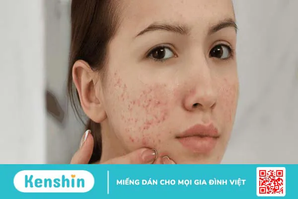 Epiduo có đẩy mụn không? Dùng Epiduo trong bao lâu thì hết mụn? 2