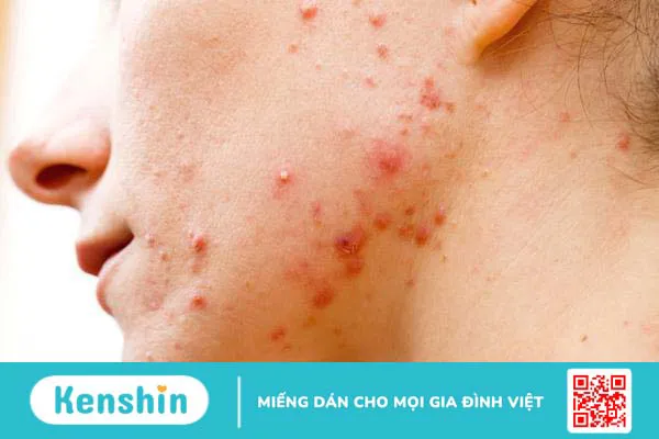 Epiduo có đẩy mụn không? Dùng Epiduo trong bao lâu thì hết mụn? 3