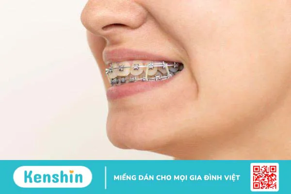 Gắn band bao lâu thì gắn mắc cài? 1