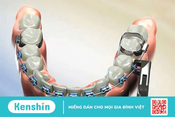 Gắn band bao lâu thì gắn mắc cài? 2